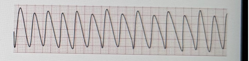 <p><span style="background-color: transparent; font-family: "Times New Roman", serif;"><span>Mr. T . arrives at the ED via an ambulance. He is pale, diaphoretic and reports crushing chest pain. His VS are HR 112, RR 24, BP 172/114, SPO2 93% on 2L NC. He has a history of angina and takes propranolol daily and nitroglycerin sublingual as needed. You suspect he is having an acute MI.</span></span></p><p><span style="background-color: transparent; font-family: "Times New Roman", serif;"><span>You notice that his rhythm, which was initially sinus tachycardia, is now this:</span></span></p><p><span style="background-color: transparent; font-family: "Times New Roman", serif;"><span>What is your initial action in this situation?</span></span></p><p><span style="font-family: "Times New Roman", serif;"><span>A. Check for a pulse</span></span></p><p><span style="background-color: transparent; font-family: "Times New Roman", serif;"><span>B. Defibrillate</span></span></p><p><span style="background-color: transparent; font-family: "Times New Roman", serif;"><span>C. Give 2 breaths</span></span></p><p><span style="background-color: transparent; font-family: "Times New Roman", serif;"><span>D. Call a code</span></span></p><p><br></p>