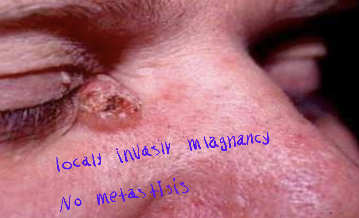 <p>basal cell carcinoma, skin</p>