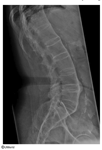 <p>23F progressive low back pain &amp; stiffness over years, worsened recently. pain <strong>relieved with activity </strong>and ibuprofen. on exam, reduced forward flexion of lumbar spine &amp; tenderness over lumbosacral area.</p><p>what does the xray show? what is most likely to diagnose this? what is the likely dx?</p>