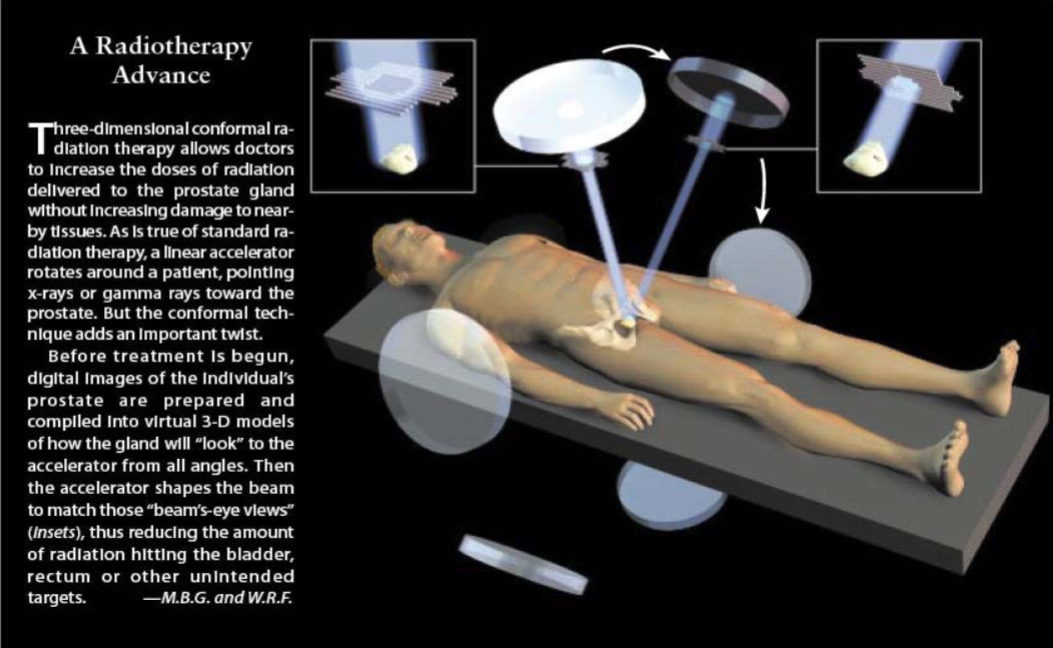 <ul><li><p>3D-CRT (3D-conformal radiation therapy): Shapes radiation beams to the prostate.</p></li><li><p>IMRT (Intensity-Modulated Radiation Therapy): More precise; adjusts beam intensity to spare healthy tissue.</p></li></ul><p></p>