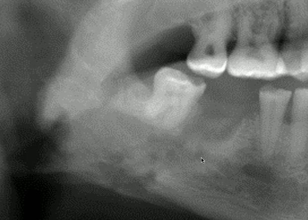<p>what is the likely diagnosis of this ill defined RL </p>