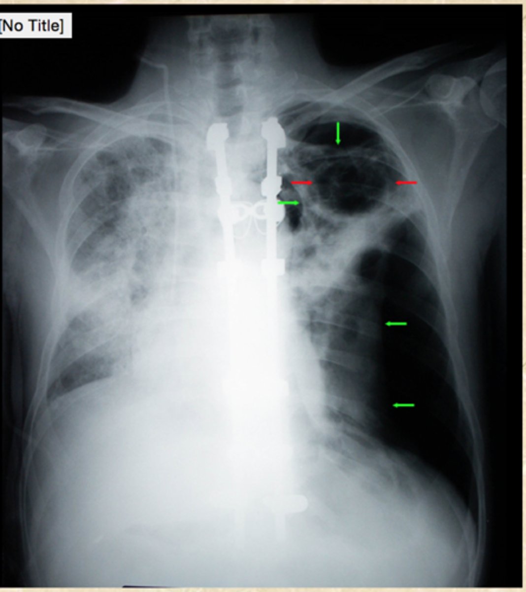 <p>What does this CXR show?</p>