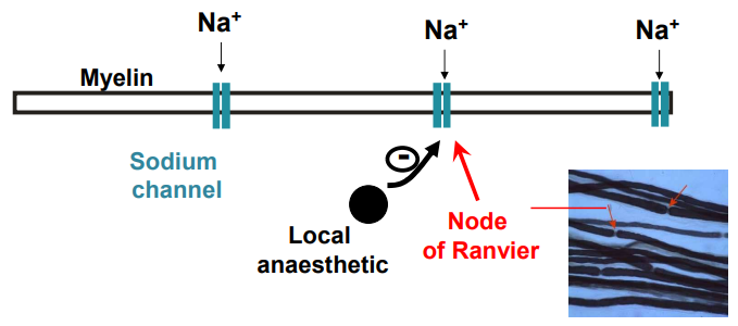 <ul><li><p class="">Local anaesthetics block nerve fibres in the order of their diameter:</p><ul><li><p class=""><strong>Aδ (1–5 μm)</strong>: Sharp pain (myelinated)</p></li><li><p class=""><strong>Type C (0.2–1.5 μm)</strong>: Dull pain &amp; autonomic postganglionic (unmyelinated)</p></li><li><p class=""><strong>Aβ (5 μm)</strong>: Sensory (myelinated)</p></li><li><p class=""><strong>Aα (12 μm)</strong>: Motor (myelinated)</p></li></ul></li><li><p class="">In <strong>myelinated fibres</strong>, local anaesthetics act at the <strong>Nodes of Ranvier</strong>.</p></li><li><p class="">The order of nerve sensitivity is:</p><ul><li><p class=""><strong>Autonomic &gt; Pain &gt; Temperature &gt; Touch &gt; Pressure (Proprioception) &gt; Skeletal Muscle Tone</strong>.</p></li></ul></li></ul><p></p>