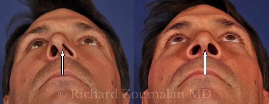 <p>The tissue structure that separates the nostrils and forms the base of the nasal tip. </p>