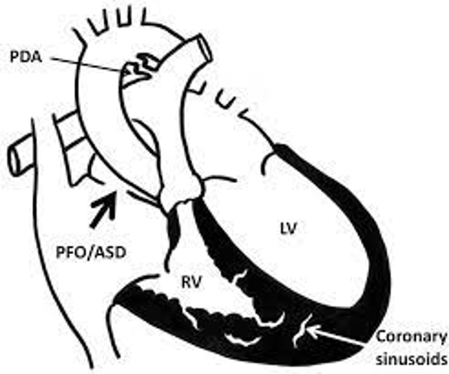 <p>do not close off sinousoids b/c they may be the only blood flow to the coronaries. The proximal portions of the coronaries may be stenotic or atretric.</p><p>Only do a systemic to pulmonary shunt and do not do transannular patch.</p><p>The coronaries are relying on a high pressure RV to send blood to coronaries and by decompressing it ,the coronaries no longer get sufficient flow.</p>