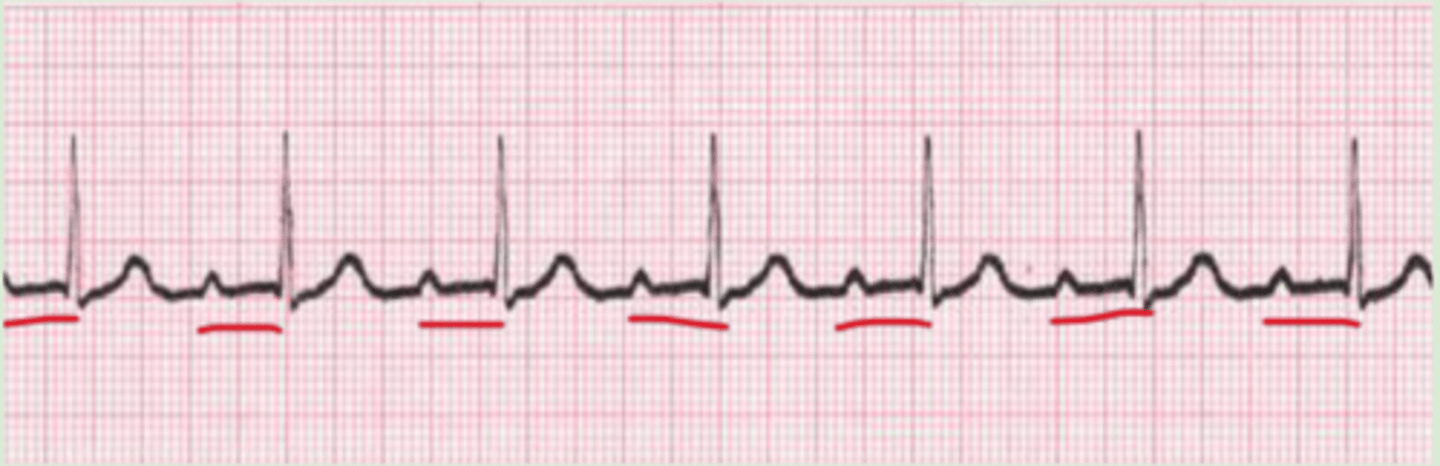 <p>Delayed impulse from SA to AV node → prolonged PR interval with each beat</p><p>-1 box large </p><p>-rest will look normal </p>