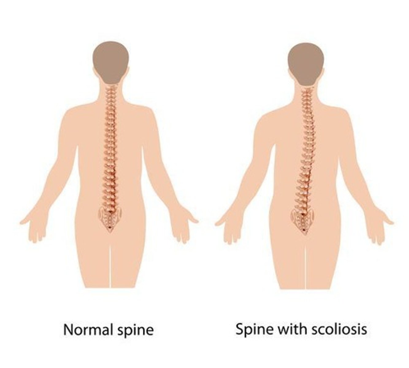 <p>Sideways curve of spine, common in teens.</p>