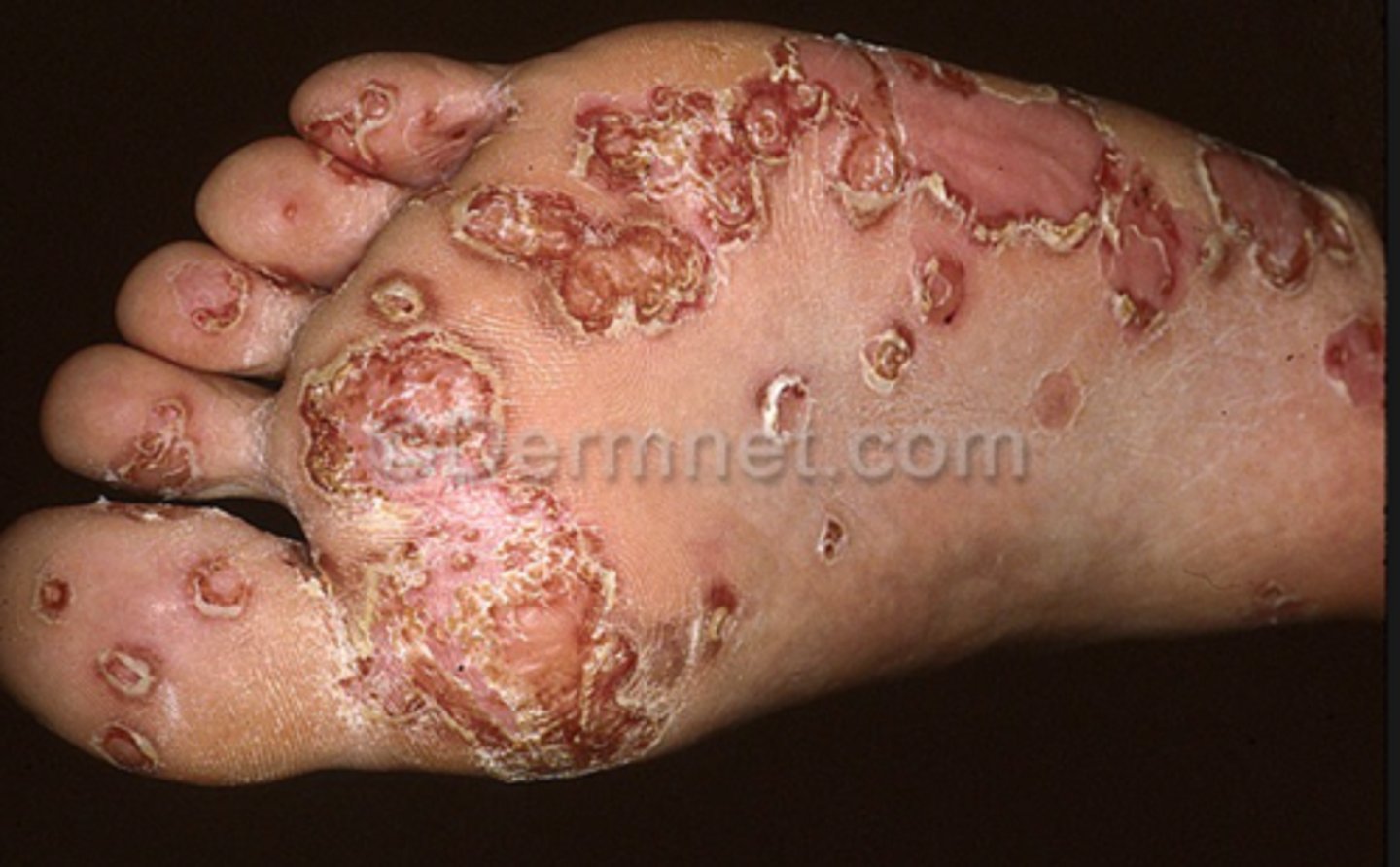 <p>reactive arthritis</p>