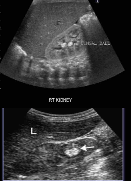 <p>What is a <span>fungal infection of urinary tract that occurs in drainage structure instead of renal</span><br><span>parenchyma?</span></p>