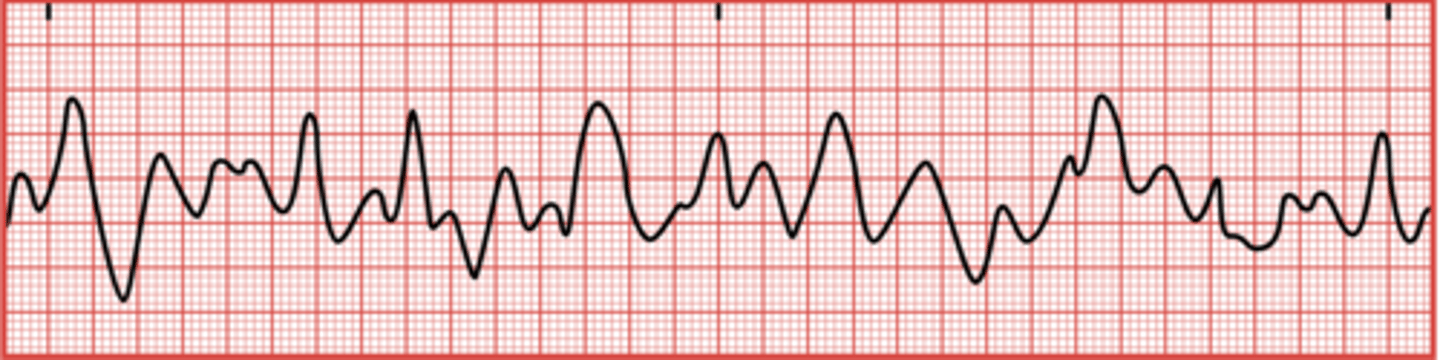 <p>A life-threatening arrhythmia where the heart muscle quivers uncontrollably, resulting in no effective blood pumping.</p>