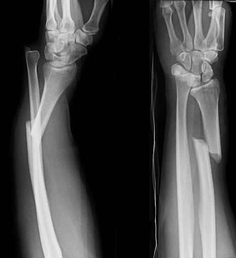 <ul><li><p>the bone is broken</p></li><li><p>the skin is broken </p></li></ul><p></p>