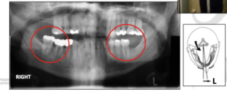 <p>Patient position - Horizontal error</p>