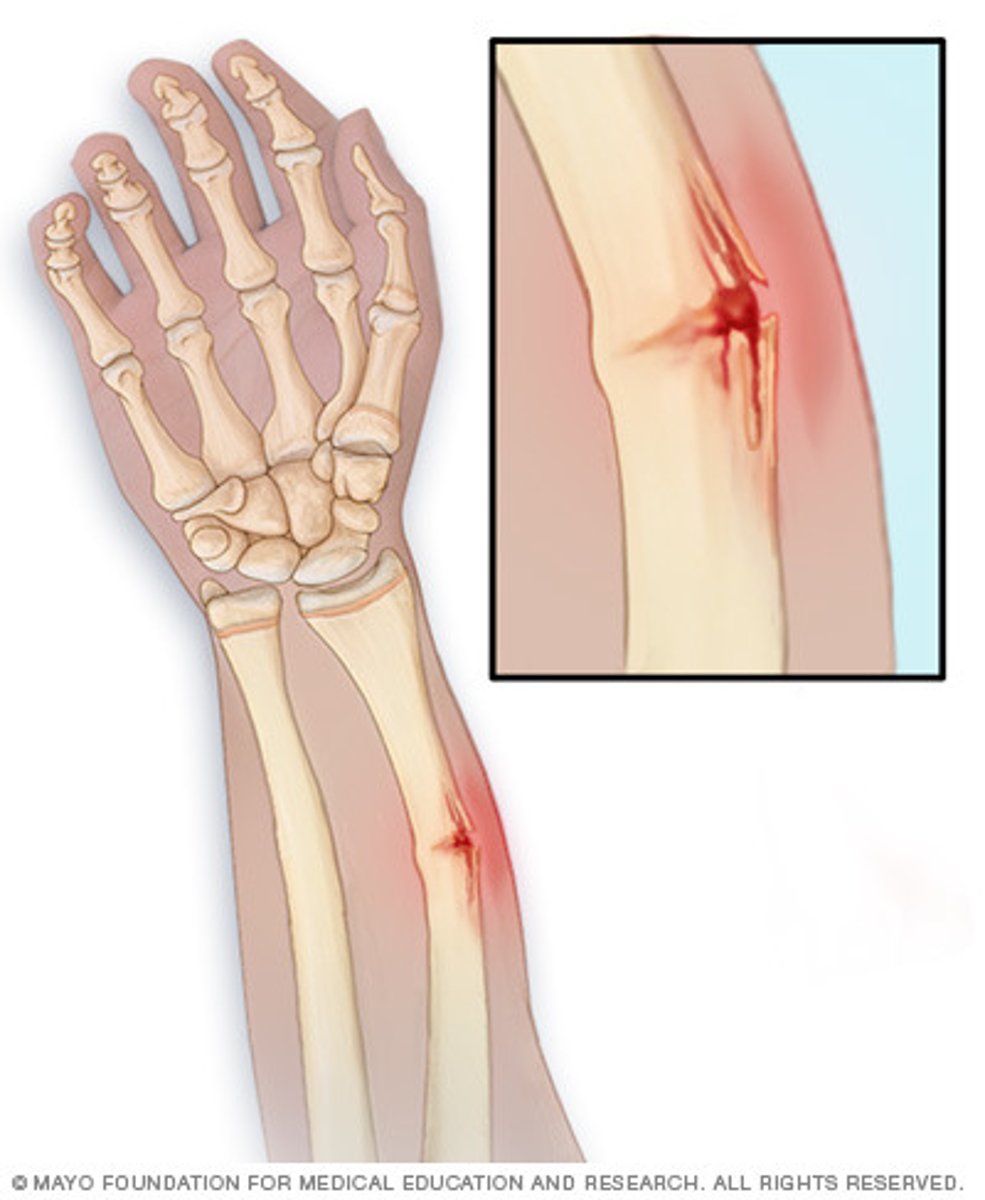 <p>bending and incomplete break of a bone; most often seen in children</p>