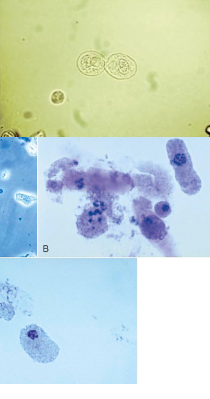 <ul><li><p class=""><strong>Smaller than squamous</strong>, <strong>larger than WBCs</strong></p></li><li><p class=""><strong>Shape</strong>: cuboidal, columnar, or round (often <strong>flattened edges</strong>)</p></li><li><p class=""><strong>Nuclei</strong> are typically <strong>eccentrically located</strong></p></li><li><p class=""><strong>0–2/hpf</strong> = normal</p></li><li><p class=""><strong>&gt;2/hpf</strong> = <strong>renal tubular damage or necrosis</strong></p><ul><li><p class="">Causes: <strong>infection</strong>, <strong>drug toxicity</strong>, <strong>heavy metals</strong>, <strong>allergic reactions</strong></p></li></ul></li><li><p class="">RTE’s reabsorb filtrate, therefor can take on various colors</p><ul><li><p class="">bilirubin → yellow color</p></li><li><p class="">Hemosiderin → yllw-brn</p></li></ul></li></ul><p></p>