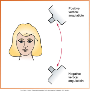 <p>Incorrect vertical angulation of the PID</p>