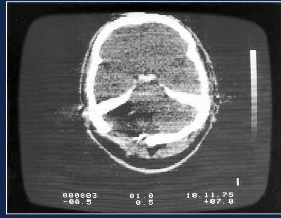 Computerized tomography (CT)