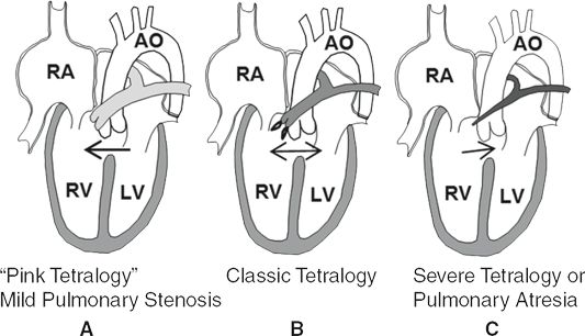 <p>Most common cyanotic defect; tetrad of large malalignment VSD, overriding aorta, RVOT obstruction, and right-ventricular hypertrophy.</p>