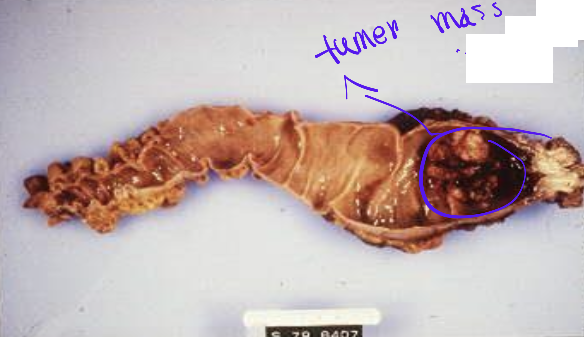 <p>Identify the <strong>organ</strong> and the <strong>diagnosis</strong> in this format: <em>diagnosis, organ</em></p>