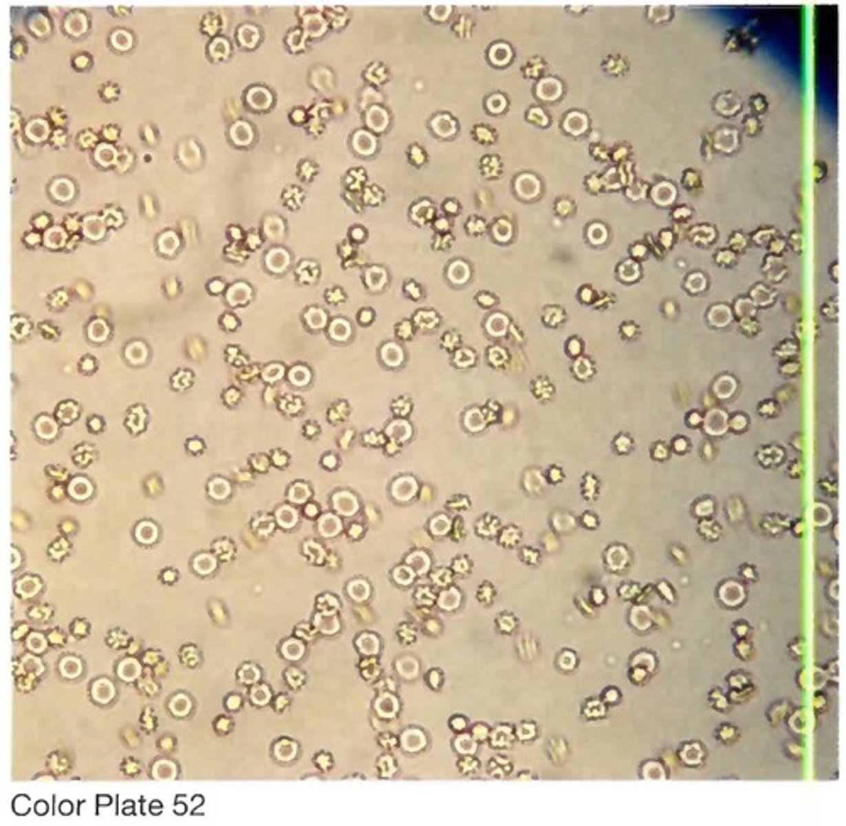 <p>A. Acute glomerulonephritis</p>