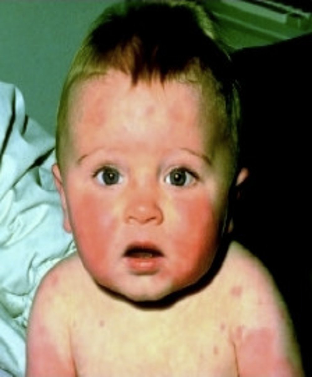 <p>Erythema Infectiosum (red-slapped cheeks; lacy patch on limbs)</p>
