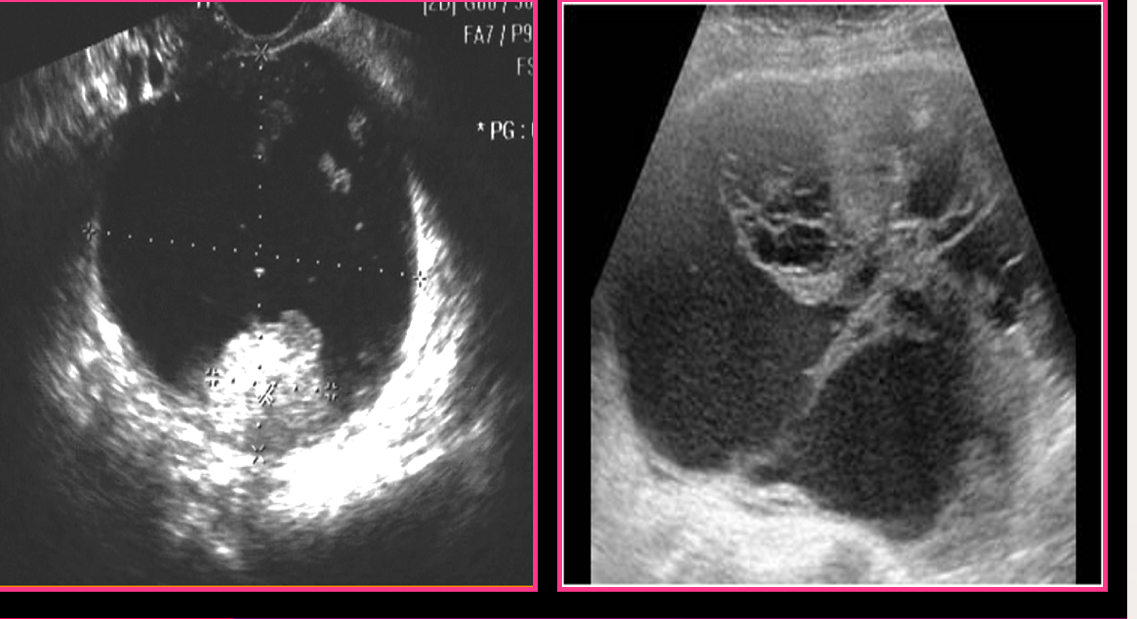 <p>Serous cystadenocarcinoma is usually ______</p>