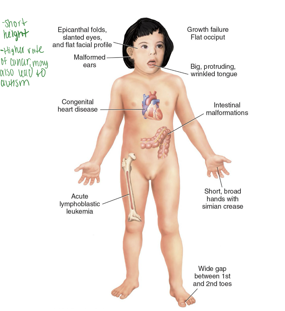 <p>Most common chromosomal disorder</p><p>Trisomy 21</p><p>Wide variation of severity</p><p>Flat facial profile, epicanthic folds around the eyes. Short height, higher rate of cancer, may also lead to autism</p><p>80% have IQ of 25 to 50</p>