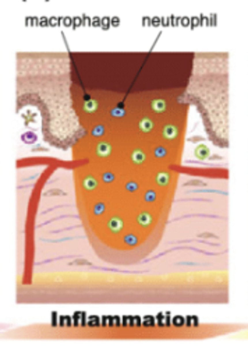 <p>Inflammatory → chronic wounds can get stuck in this phase</p>