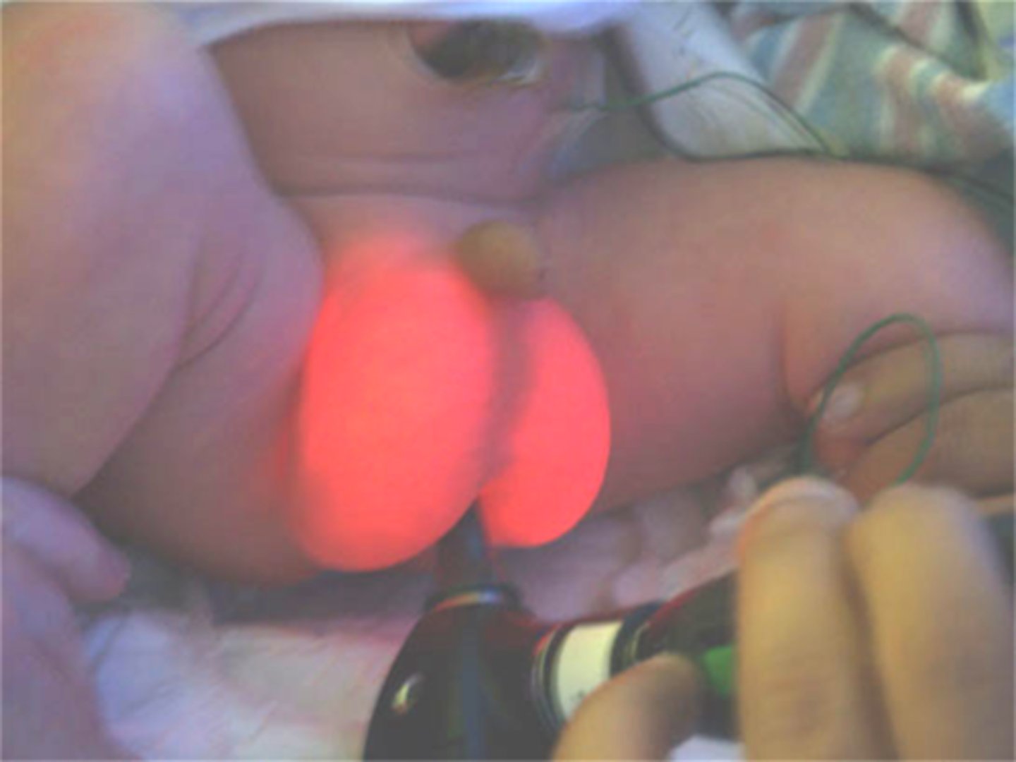 <p>Fluid accumulation within the remnant tunica vaginalis that appears as a soft tender swelling of the scrotum that transilluminates; US; no - usually resolves by 1 y/o</p>