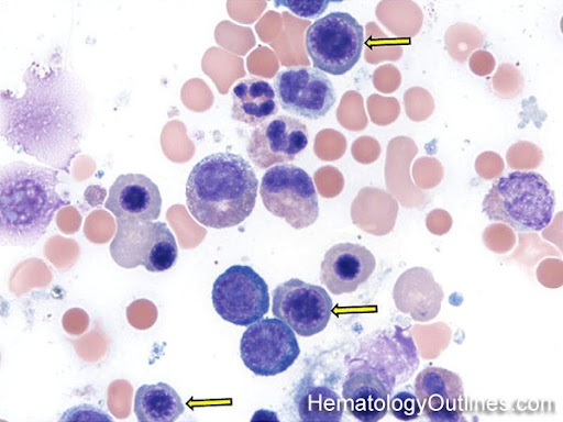 <ul><li><p>size: 13 micrometers</p></li><li><p>NC ratio: 4:1</p></li><li><p>cytoplasm: blue, with tinges of red-orange</p></li></ul><p></p>
