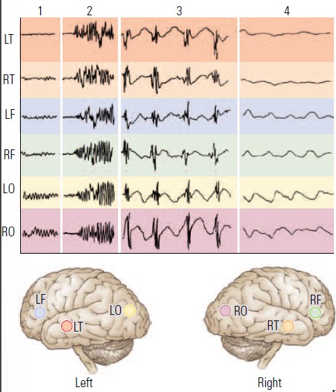 * waves recruits adjacent regions
* in pic, can tell RO has biggest spikes → suggest that location is here
* EEG waves compared via computer techniques 
