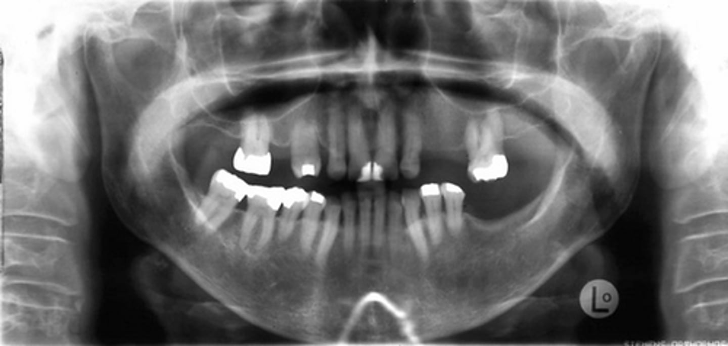 <p>What is the pathology depicted in the image showing a net decrease of bone formation?</p>