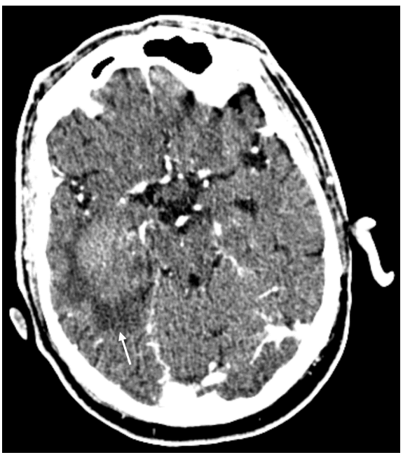 <p>What is shown in this CT image?</p>