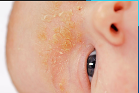 <p><strong>Seborrheic Dermatitis: Presentation, Diagnosis, Treatment</strong></p><p>-Adolescents (________)</p><ul><li><p>Scalp most often affected </p></li><li><p>Fine, white, dry ________ of the scalp</p></li><li><p>May have minor itching </p></li></ul><p>-Diagnosis → clinical</p><p>-Treatment </p><ul><li><p>Frequent shampooing can help remove scale </p></li><li><p>Cradle cap → can apply ____ (mineral or olive), allow to sit for a few minutes then gently brush and shampoo</p></li><li><p>Adolescents → ____________, selenium sulfate, or salicylic acid _________</p></li></ul><p></p>