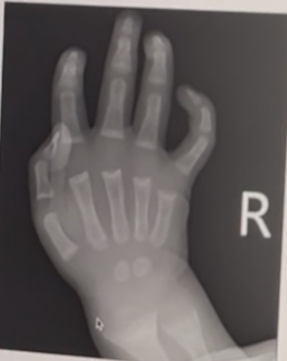 <p>paintbrush metaphysis</p><p>3 multiple choice options</p>