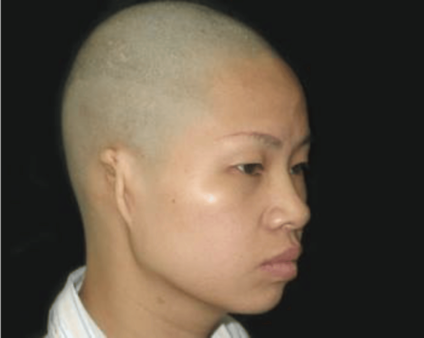 <p>malformation of external auditory canal</p>