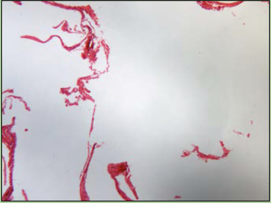 What disorder is this?