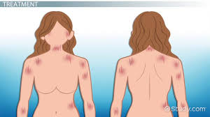 <p>Force on skin: sliding bed=injury to tissue</p>