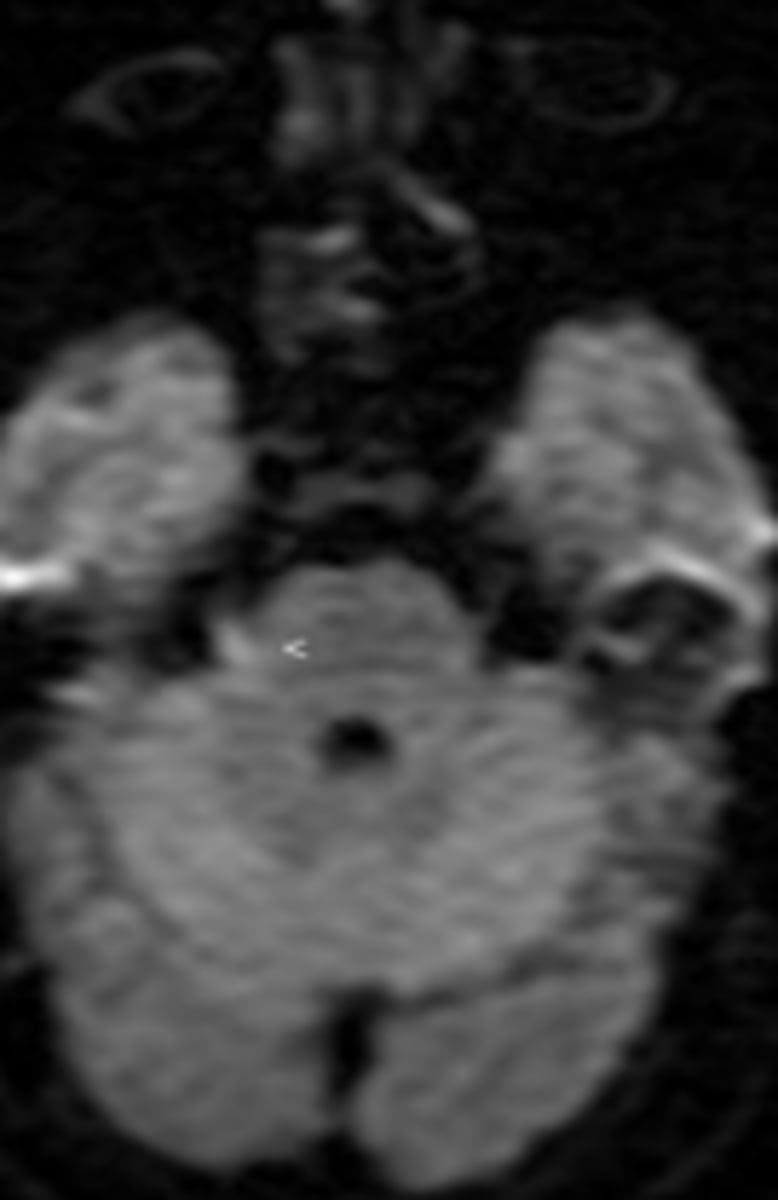 <p>MRI sequence used for tumor characterization and cerebral ischemia</p>