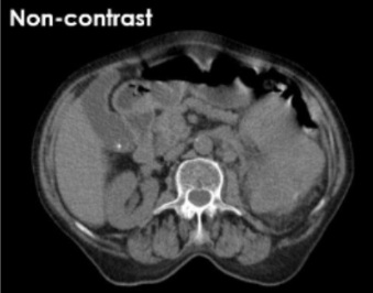 <p><span style="color: rgb(63, 135, 80)">CT Kidneys </span><span style="color: #000000">scan 1 </span></p>