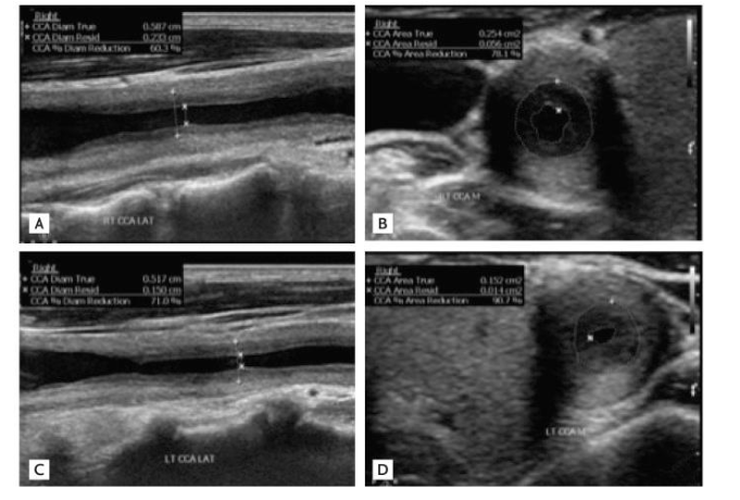 <p>What is Takayasu’s arteritis, how does it look on ultrasound </p>