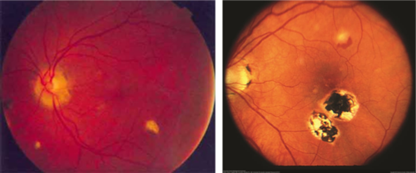 <p>"punched-out" chorioretinal scars aka "histo spots" = outer retinal atrophy of ONL, PR's, RPE = scarring = yellow-white sclera or darker RPE hyperplasia</p><p>PPA = often further out, more irregular that crescents</p><p>absence of vitritis = white translucent dots floating in vitreous</p>