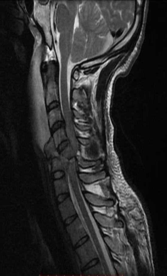 <p>Name the main pathology demonstrated.</p>