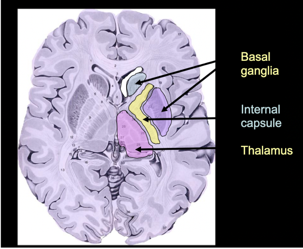 * anterior limb
* genu
* posterior limb
* rentrolenticular limb 
* visual & auditory radiation 