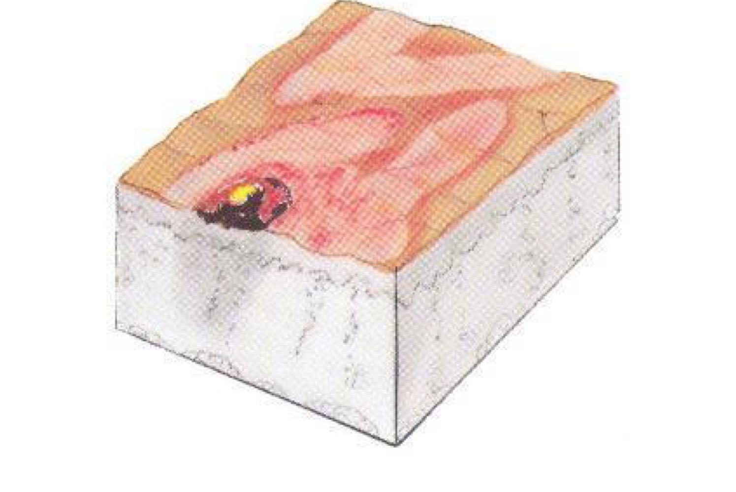 <p>what type of skin lesion is this? </p>