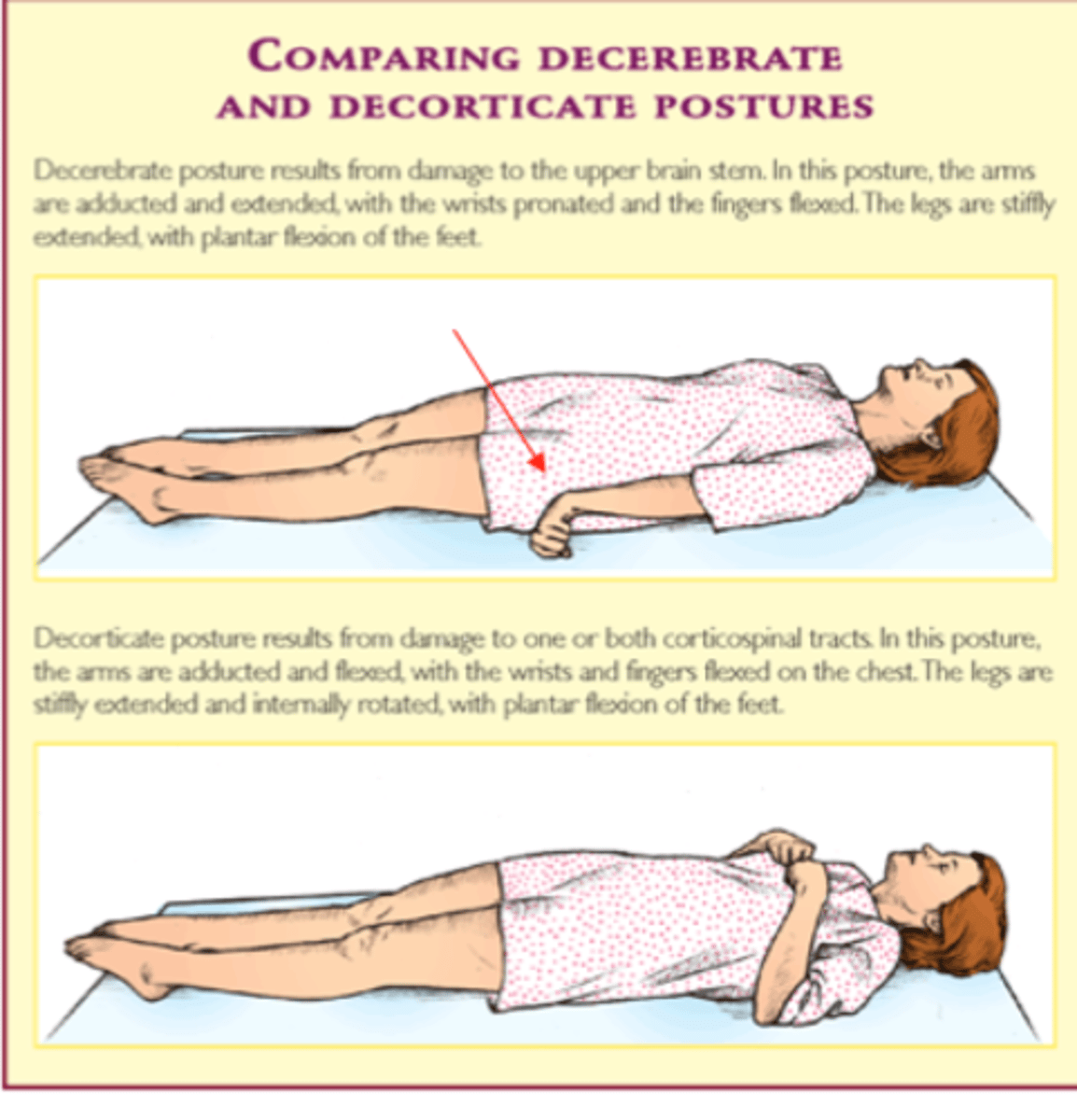 <p>- lesion below the red nucleus</p>