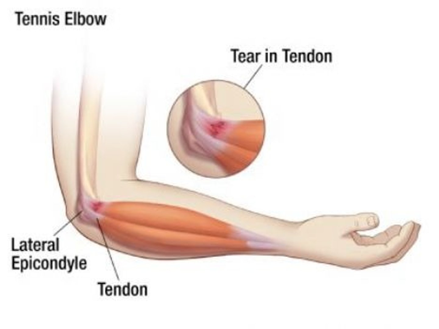 <p>Inflammation of the extensor muscles of the forearm, caused by overuse or trauma</p>