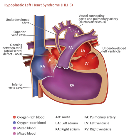 <p><strong><u>Mixed</u> Defect</strong></p><ul><li><p class=""><em>Very small left ventricle and a very large right ventricle to compensate</em>.</p></li><li><p class="">Often diagnosed prenatally.</p></li><li><p class="">Requires several surgeries.</p></li><li><p class=""><strong><u>Often leads to transplant</u></strong>.</p></li></ul><p></p>
