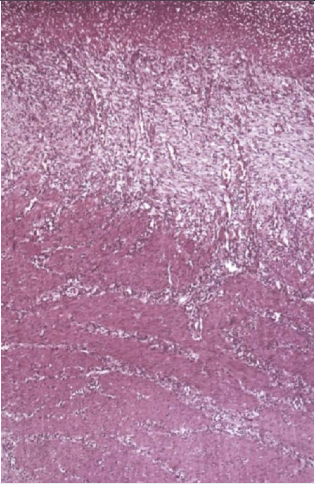 <p>Scar tissue- pale and pinkish </p><p>Bottom part: muscle with canals of lymphocytes and slits in the faded part are blood vessels </p>