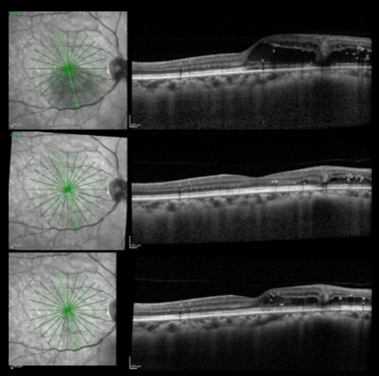 <p>What are we looking for at the post-laser f/u for mac edema?</p>