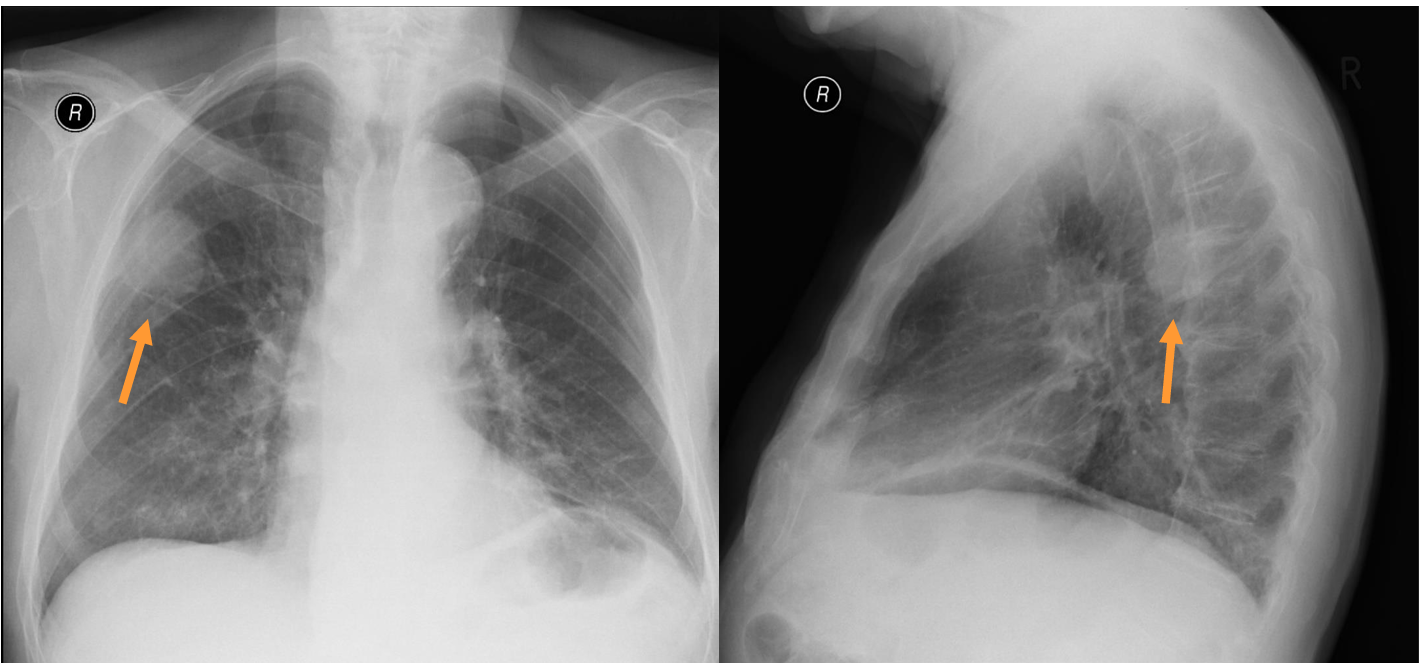 <p>Patient history: chest screening in an asymptomatic middle-aged patient </p><p>Modality: left– PA chest radiograph right – left lateral chest radiograph </p><p>Region:chest </p><p>Radiologic sign: peripheral, well-circumscribed, novel (compared to older films) mass in the right upper lobe </p><p>Diagnosis: lung adenocarcinoma</p>